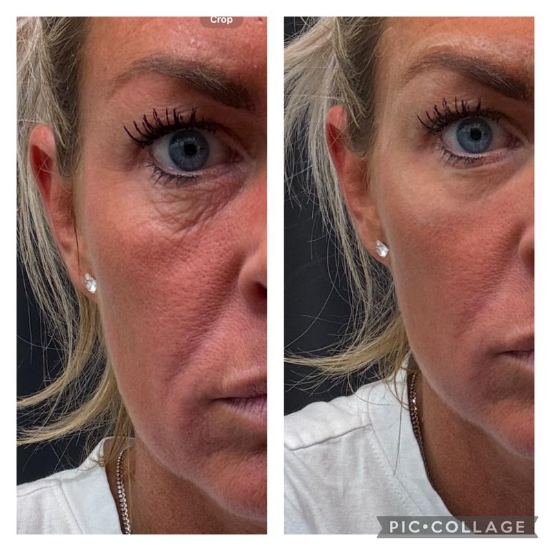 Instant Oogkringen- en Rimpelcrème