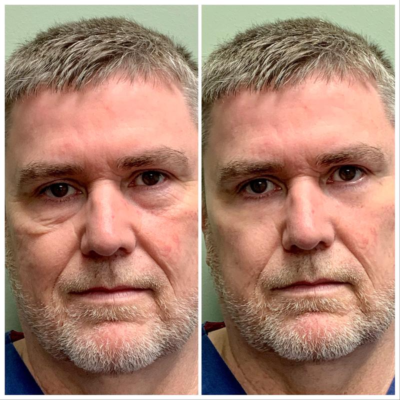 Instant Oogkringen- en Rimpelcrème